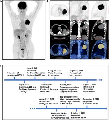 Anti-PD-1 sintilimab-induced bilateral optic neuropathy in non-small cell lung cancer: A case report and literature review